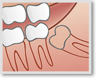 Weisheitszahn